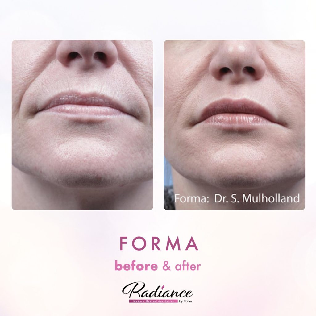 Forma Before & After Gallery - Patient 12665 - Image 1