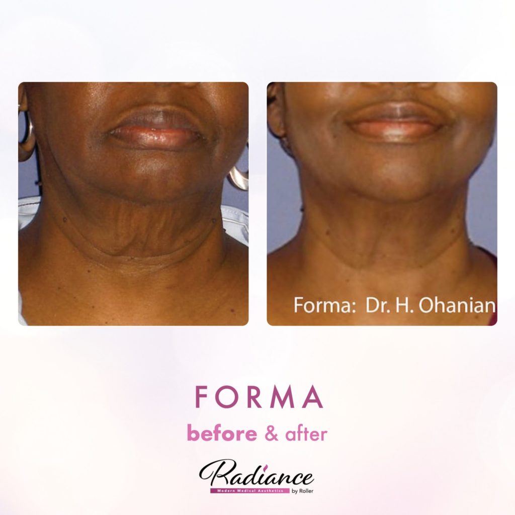 Forma Before & After Gallery - Patient 12654 - Image 1