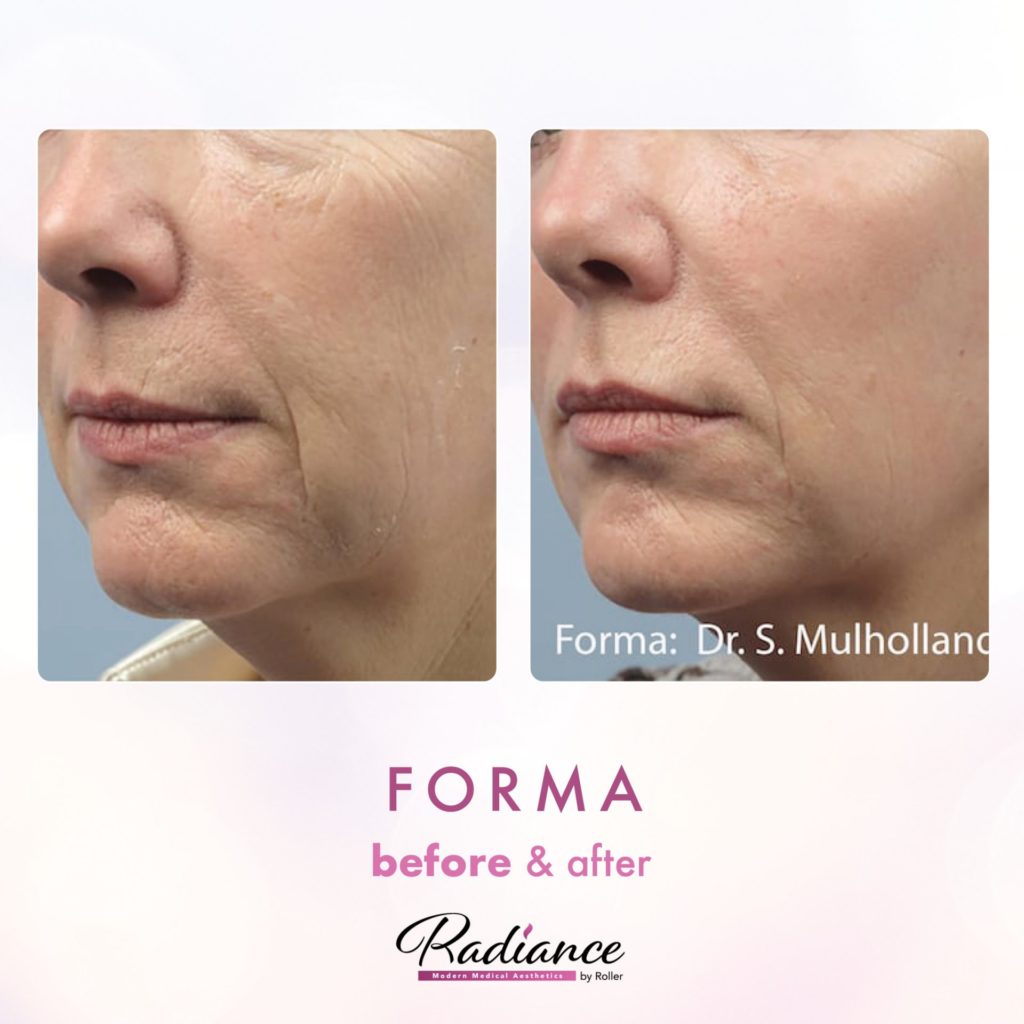 Forma Before & After Gallery - Patient 12653 - Image 1