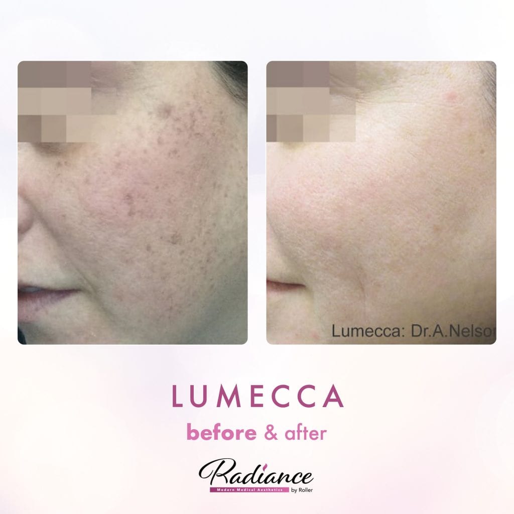 Lumecca Before & After Gallery - Patient 12692 - Image 1
