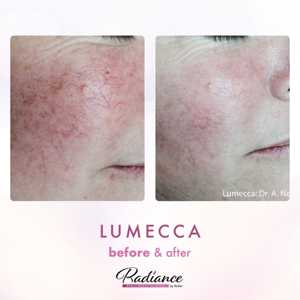 Lumecca Before & After Gallery - Patient 12691 - Image 1