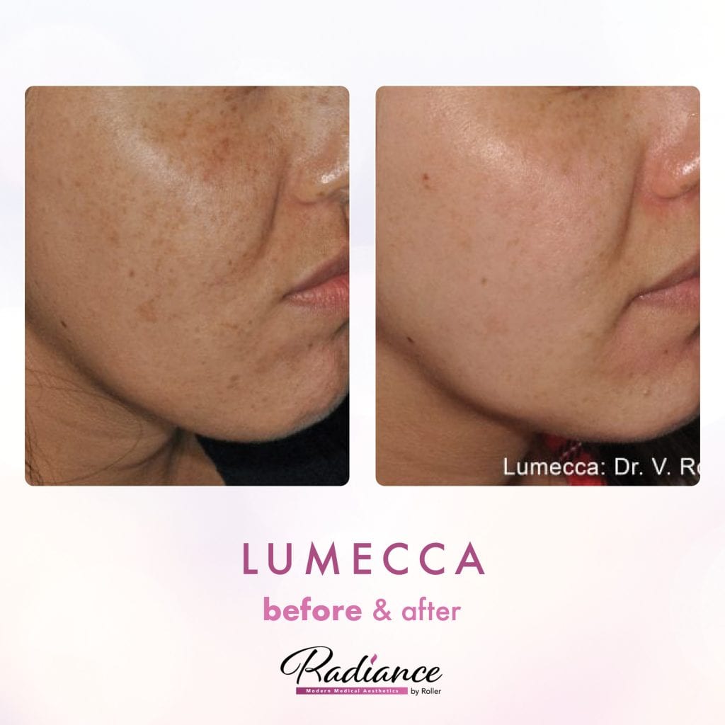 Lumecca Before & After Gallery - Patient 12690 - Image 1