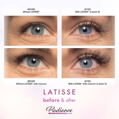 LATISSE® Before & After Gallery - Patient 13181 - Image 1