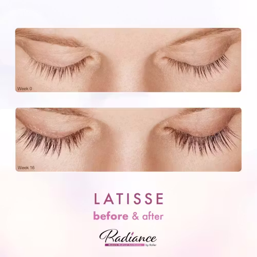 LATISSE® Before & After Gallery - Patient 13179 - Image 1