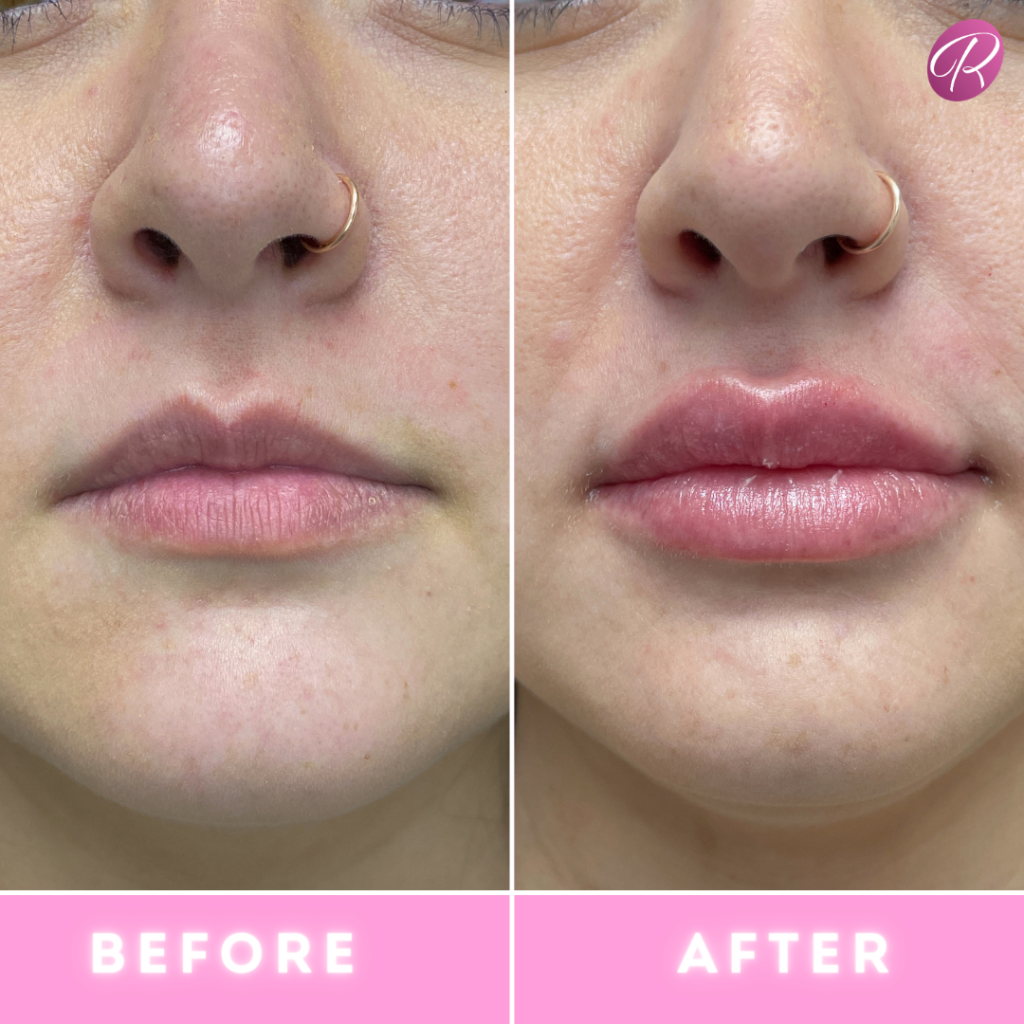 Fillers Before & After Gallery - Patient 12479 - Image 1