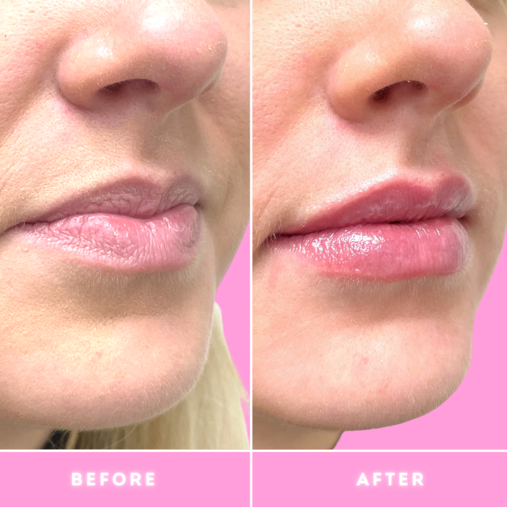 Fillers Before & After Gallery - Patient 12475 - Image 1