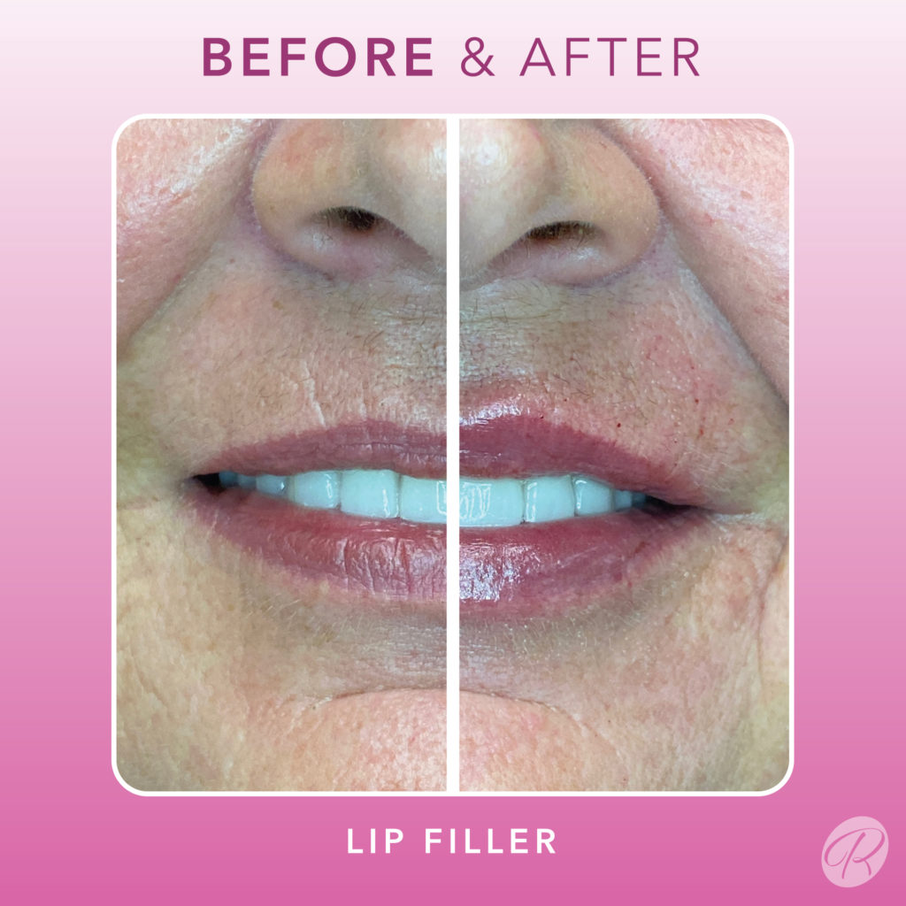 Fillers Before & After Gallery - Patient 12473 - Image 1
