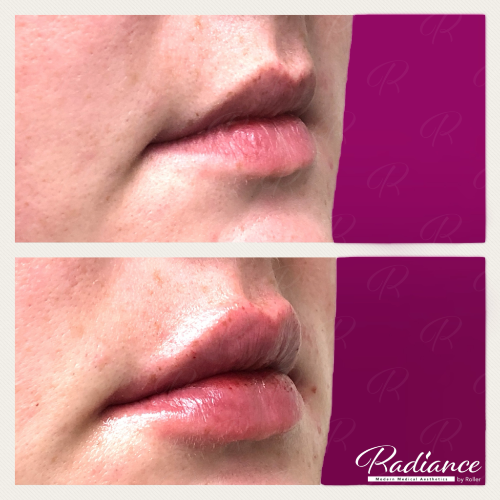 Fillers Before & After Gallery - Patient 12470 - Image 1