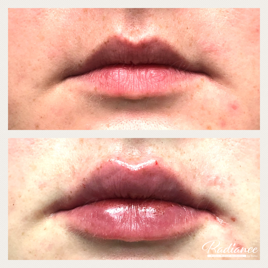 Fillers Before & After Gallery - Patient 12470 - Image 3