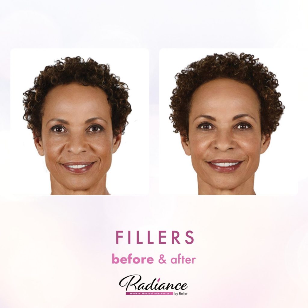 Fillers Before & After Gallery - Patient 12468 - Image 1