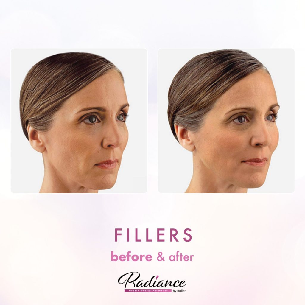 Fillers Before & After Gallery - Patient 12466 - Image 1
