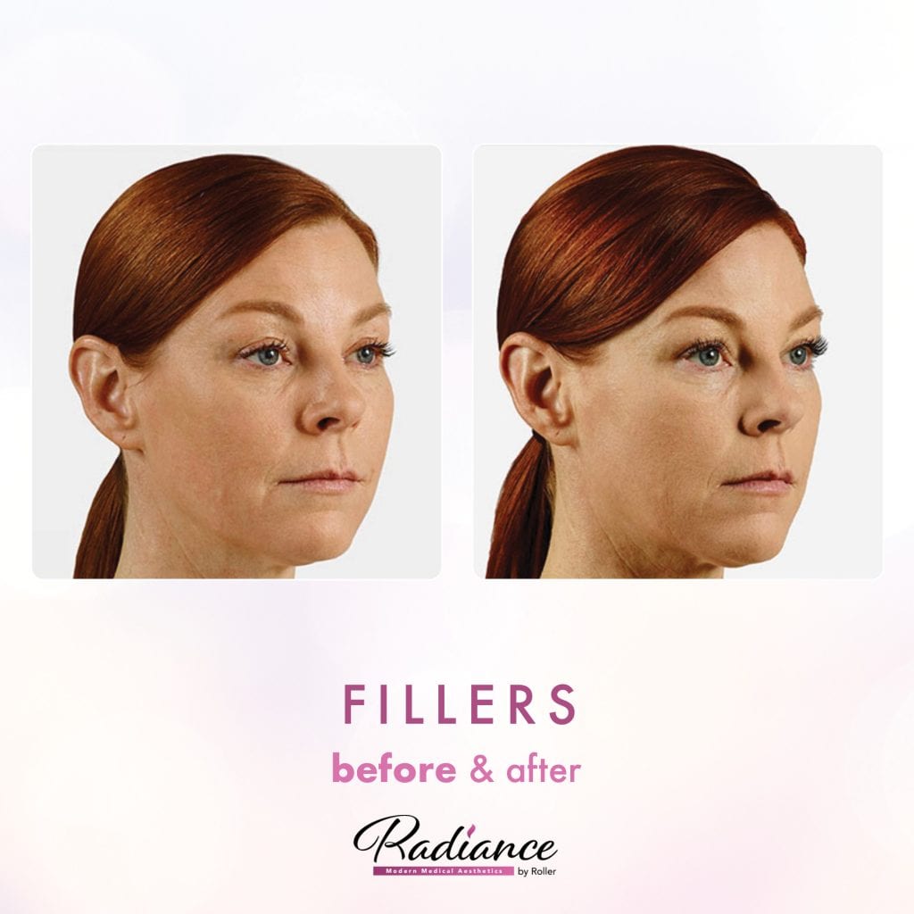 Fillers Before & After Gallery - Patient 12464 - Image 1