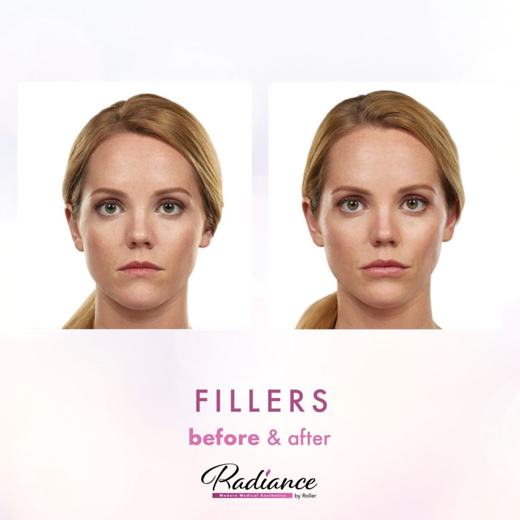 Fillers Before & After Gallery - Patient 12462 - Image 1
