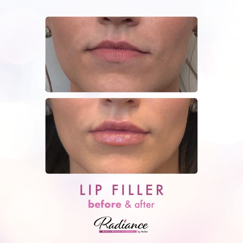 Fillers Before & After Gallery - Patient 12460 - Image 1