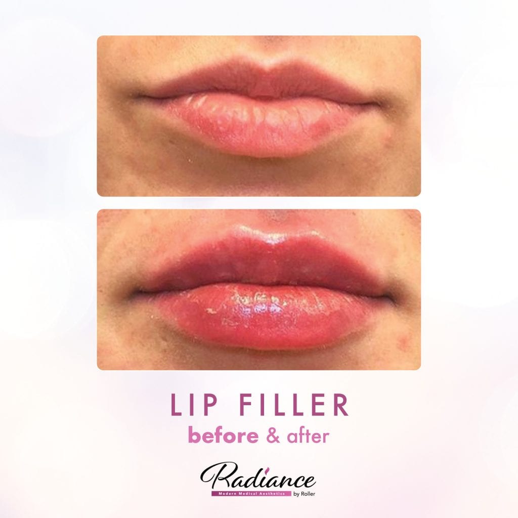 Fillers Before & After Gallery - Patient 12458 - Image 1