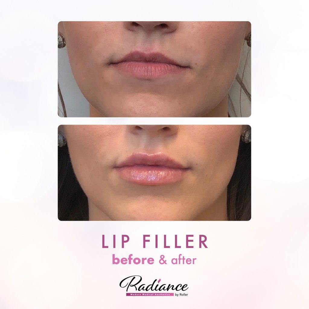 Fillers Before & After Gallery - Patient 12456 - Image 1