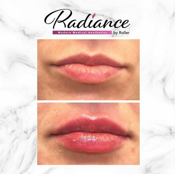 Fillers Before & After Gallery - Patient 12453 - Image 1