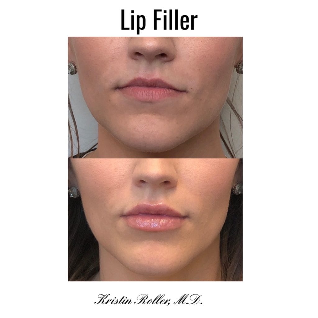 Fillers Before & After Gallery - Patient 12451 - Image 1