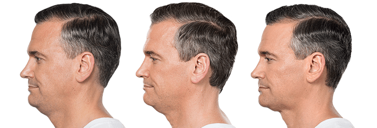 KYBELLA Before & After Gallery - Patient 12634 - Image 1