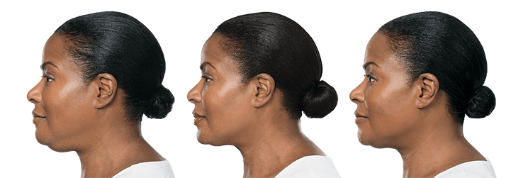 KYBELLA Before & After Gallery - Patient 12633 - Image 1