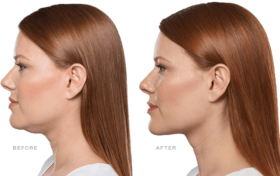 KYBELLA Before & After Gallery - Patient 12632 - Image 1