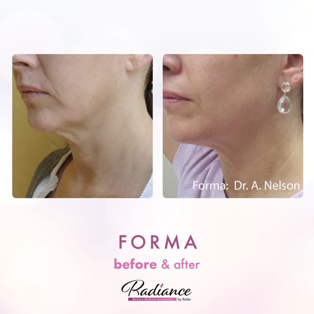 Forma Before & After Gallery - Patient 12658 - Image 1