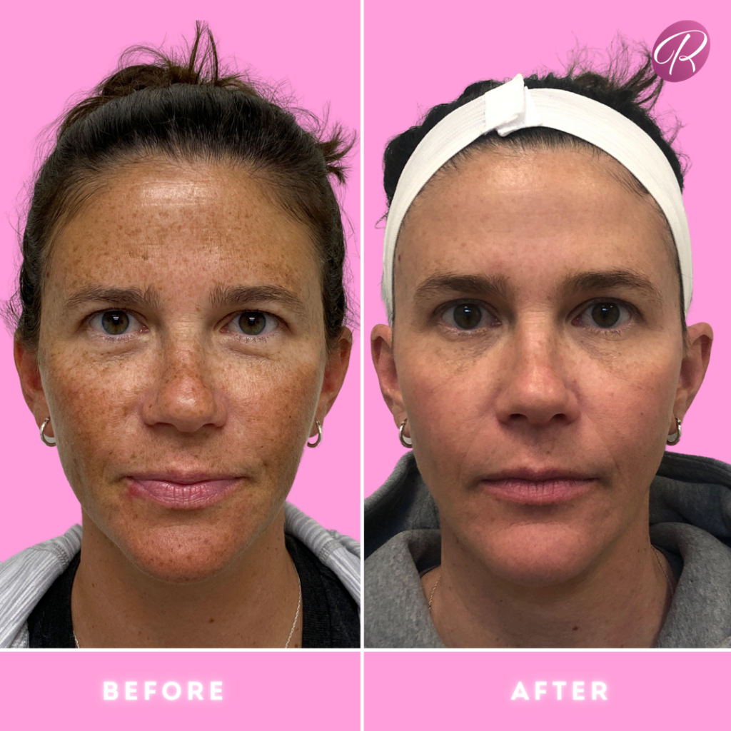 Lumecca Before & After Gallery - Patient 12696 - Image 1