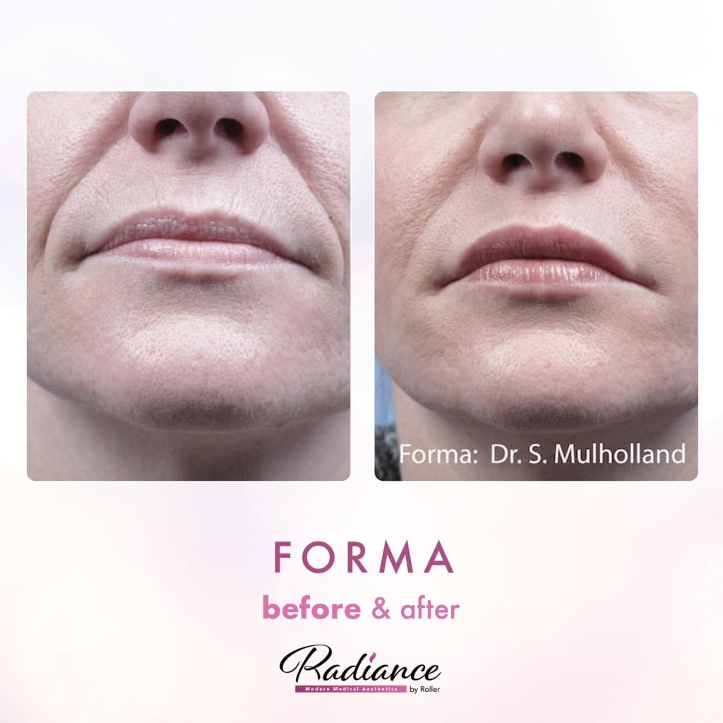 Forma Before & After Gallery - Patient 12656 - Image 1