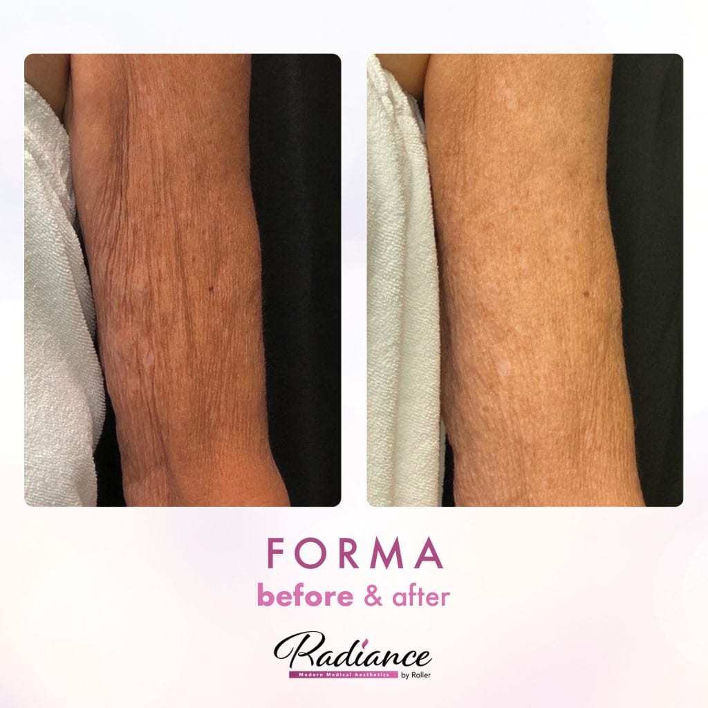 Forma Before & After Gallery - Patient 12651 - Image 1