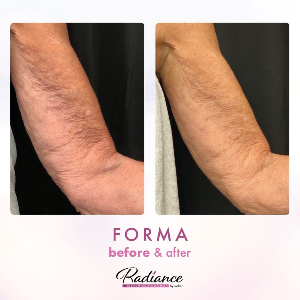 Forma Before & After Gallery - Patient 12649 - Image 1
