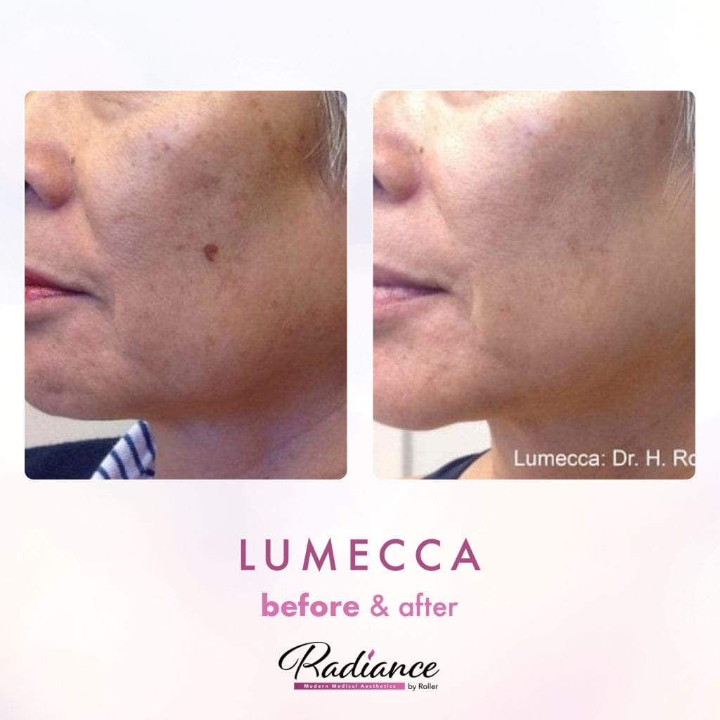 Lumecca Before & After Gallery - Patient 12686 - Image 1