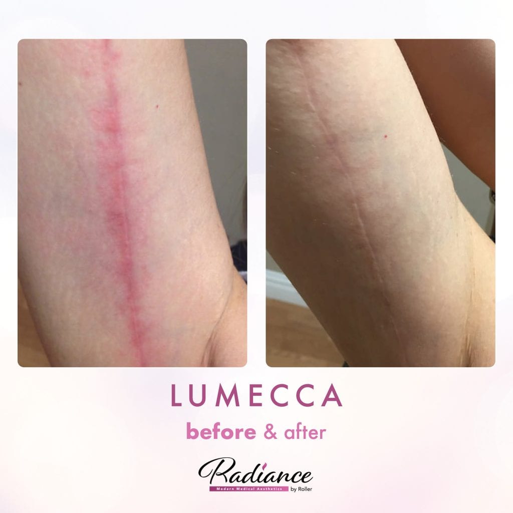 Lumecca Before & After Gallery - Patient 12684 - Image 1
