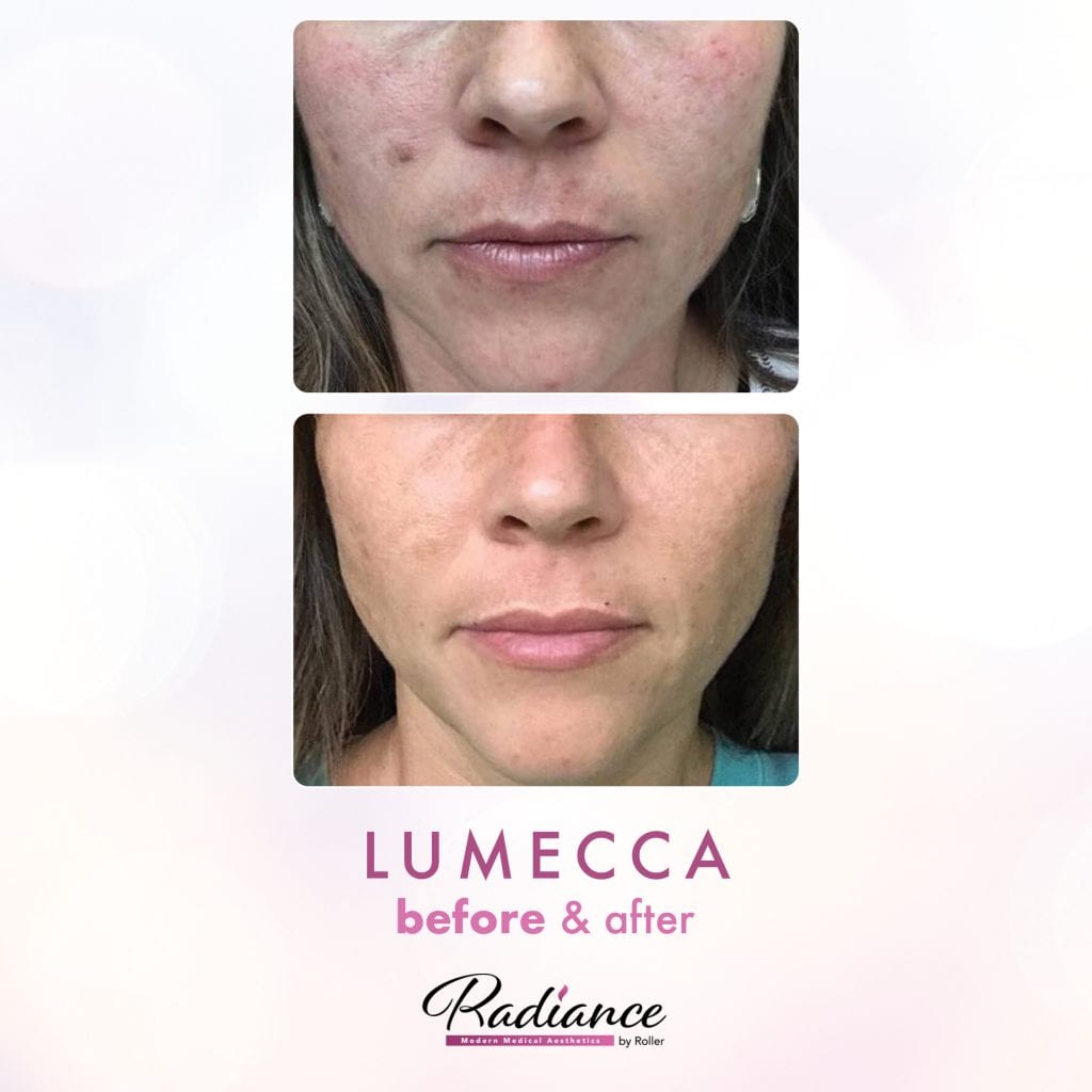 Lumecca Before & After Gallery - Patient 12680 - Image 1