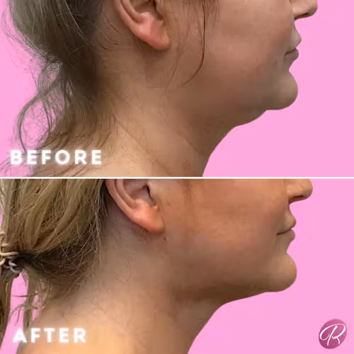 FaceTite Before & After Gallery - Patient 12878 - Image 1