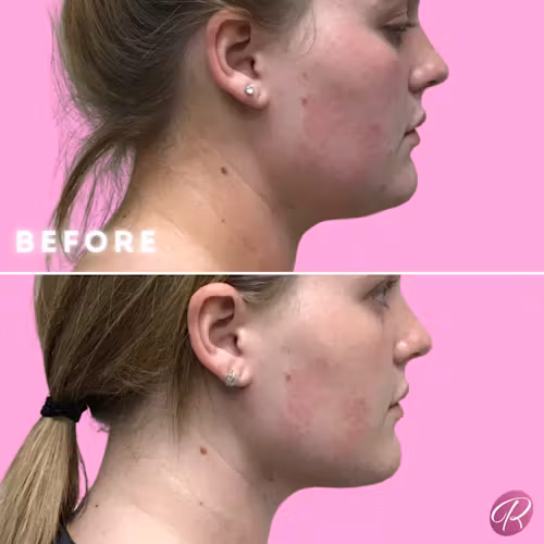 FaceTite Before & After Gallery - Patient 12877 - Image 1