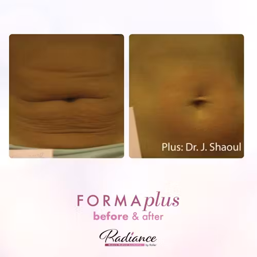 FormaPlus Before & After Gallery - Patient 13111 - Image 1