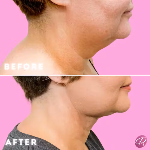 FaceTite Before & After Gallery - Patient 12876 - Image 1