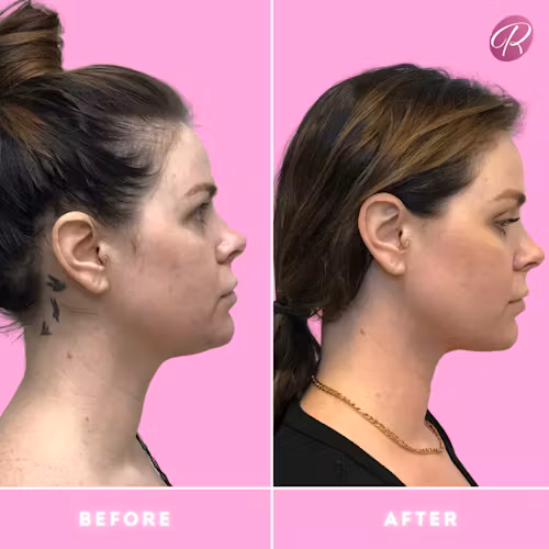 Accutite Before & After Gallery - Patient 13104 - Image 1