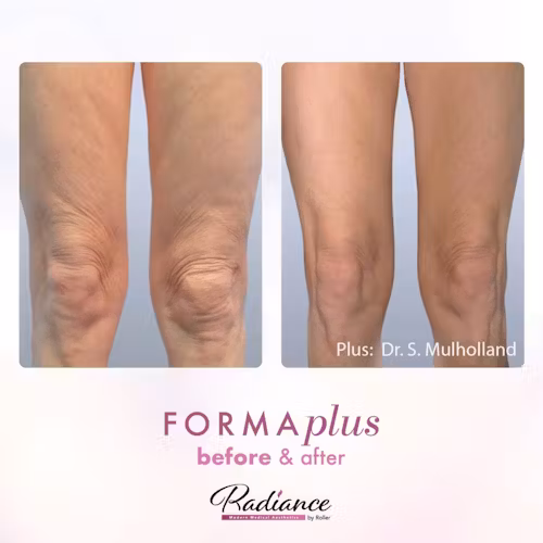 FormaPlus Before & After Gallery - Patient 13109 - Image 1