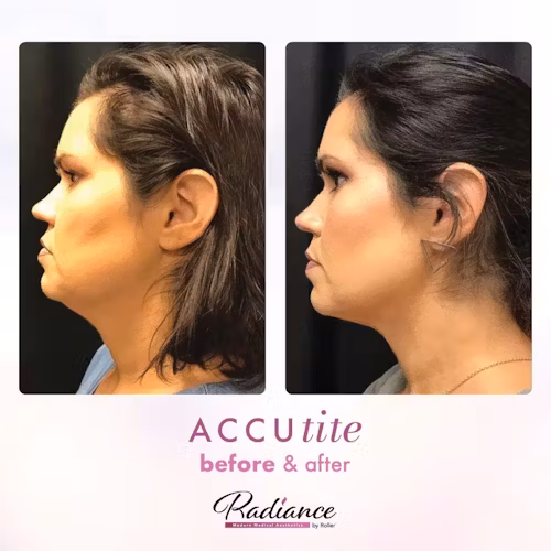 Accutite Before & After Gallery - Patient 13107 - Image 1