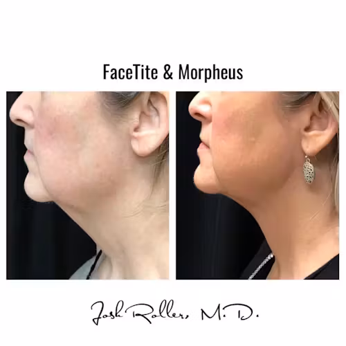 Morpheus8 Before & After Gallery - Patient 13098 - Image 1