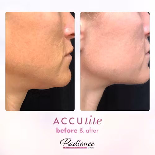 Accutite Before & After Gallery - Patient 13106 - Image 1