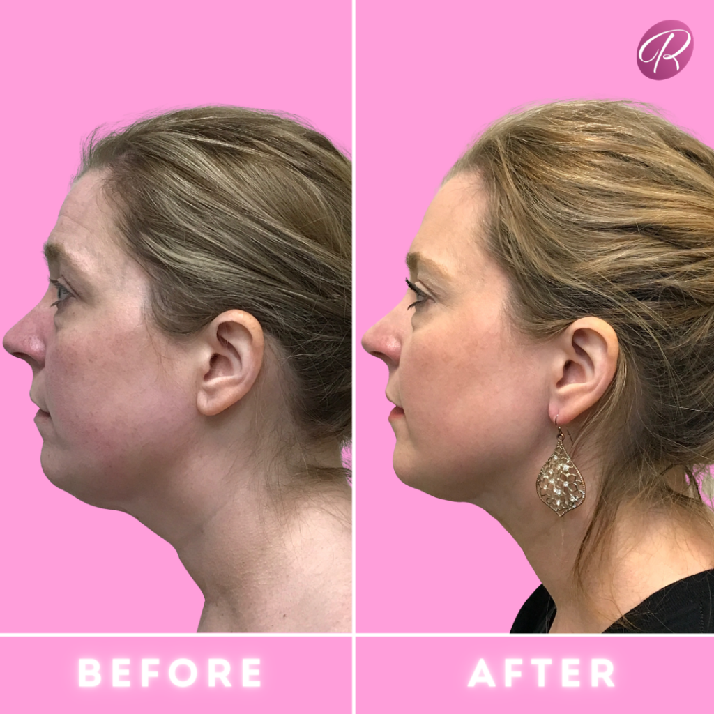 FaceTite Before & After Gallery - Patient 12871 - Image 1