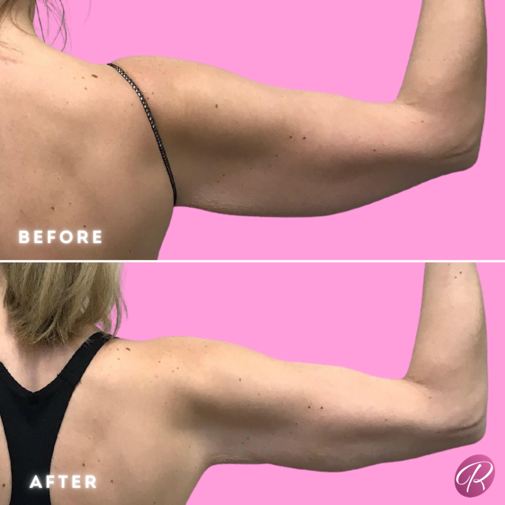 BodyTite Before & After Gallery - Patient 12820 - Image 2