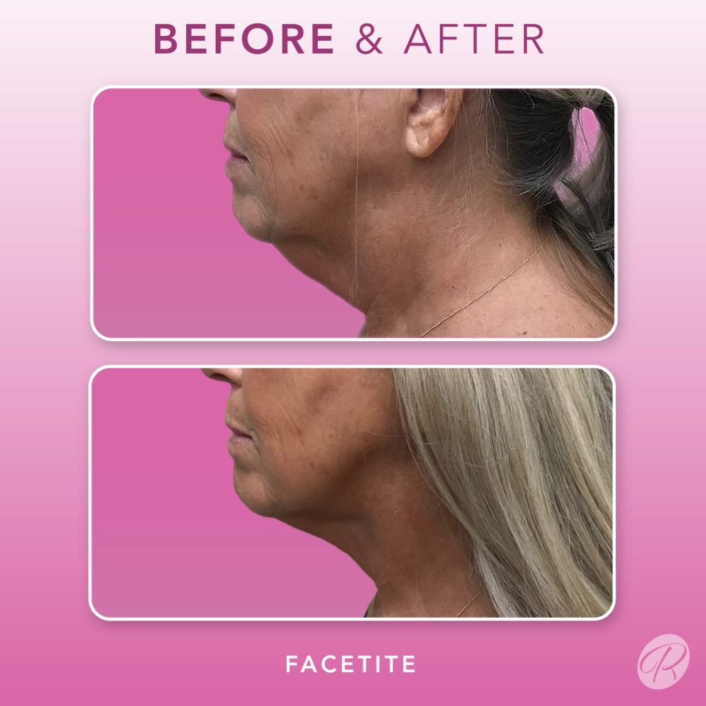 FaceTite Before & After Gallery - Patient 12869 - Image 1