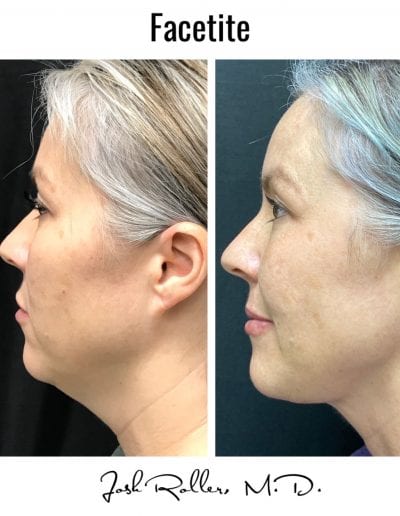 FaceTite Before & After Gallery - Patient 12866 - Image 2