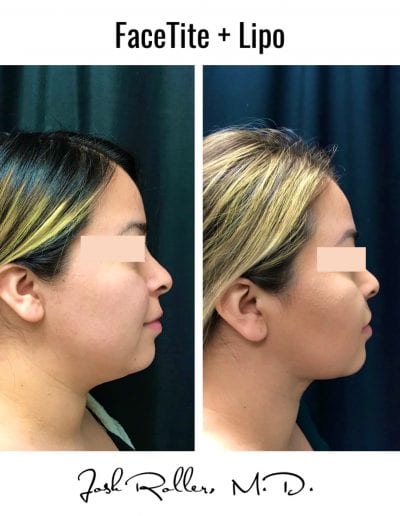 FaceTite Before & After Gallery - Patient 12863 - Image 1