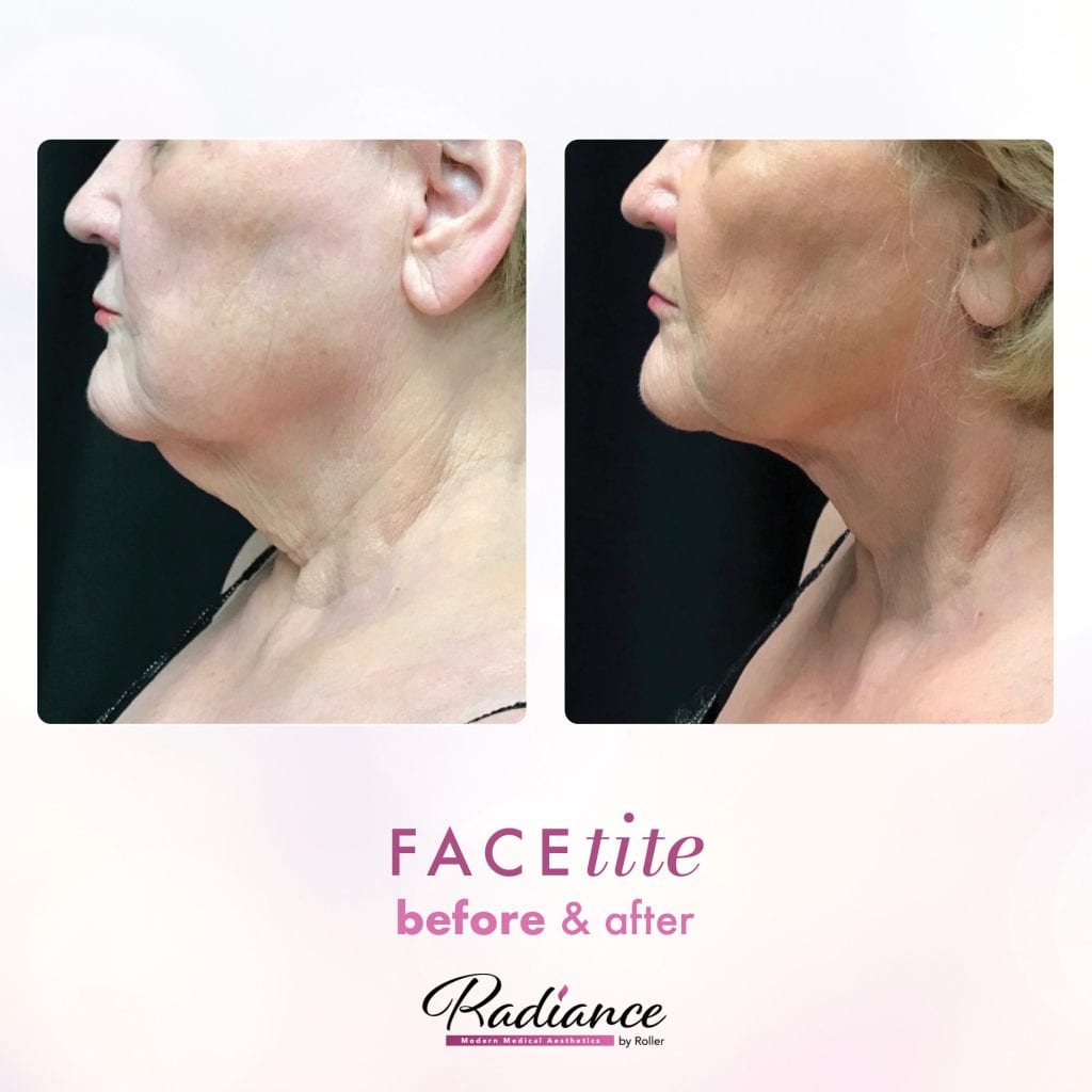 FaceTite Before & After Gallery - Patient 12860 - Image 1