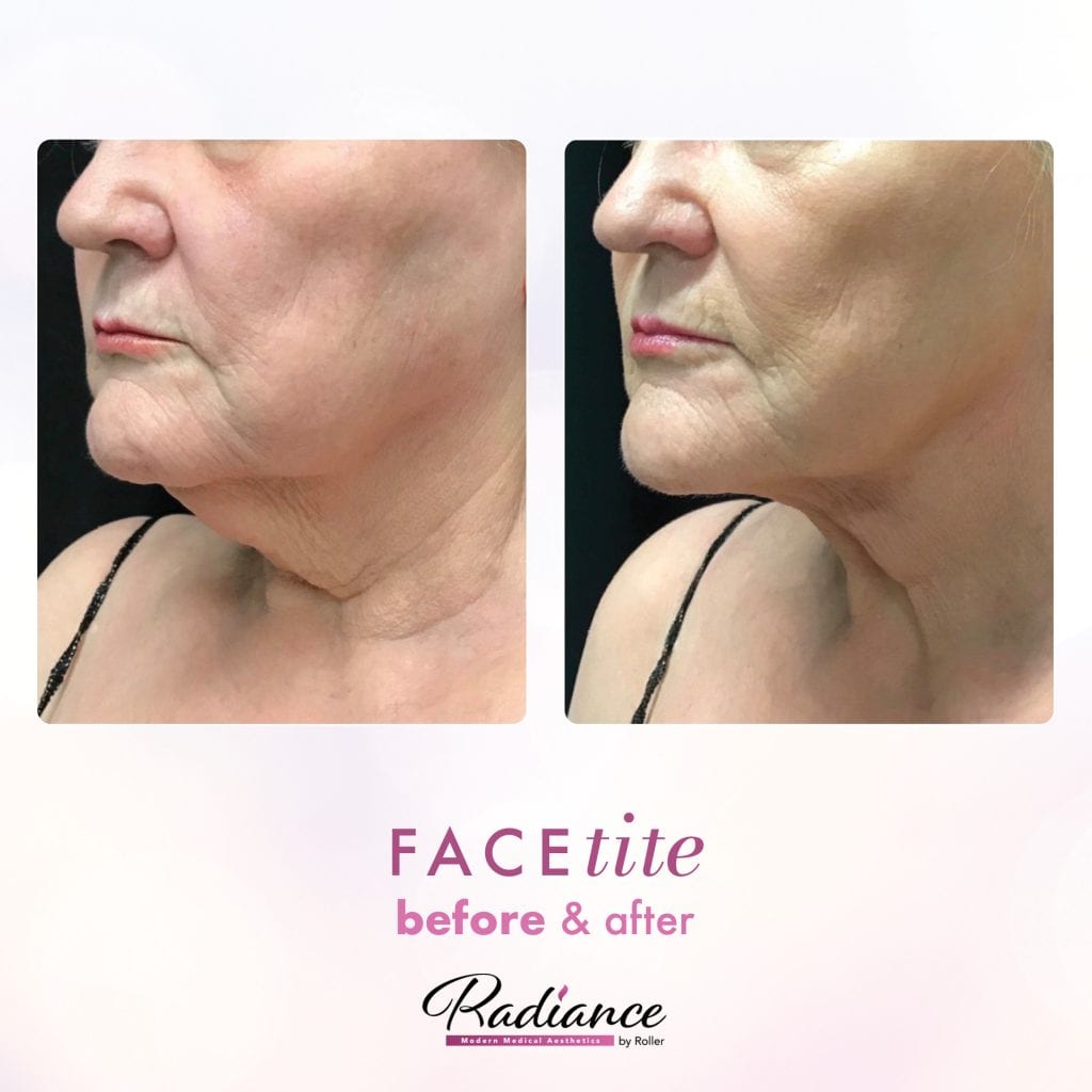 FaceTite Before & After Gallery - Patient 12860 - Image 2