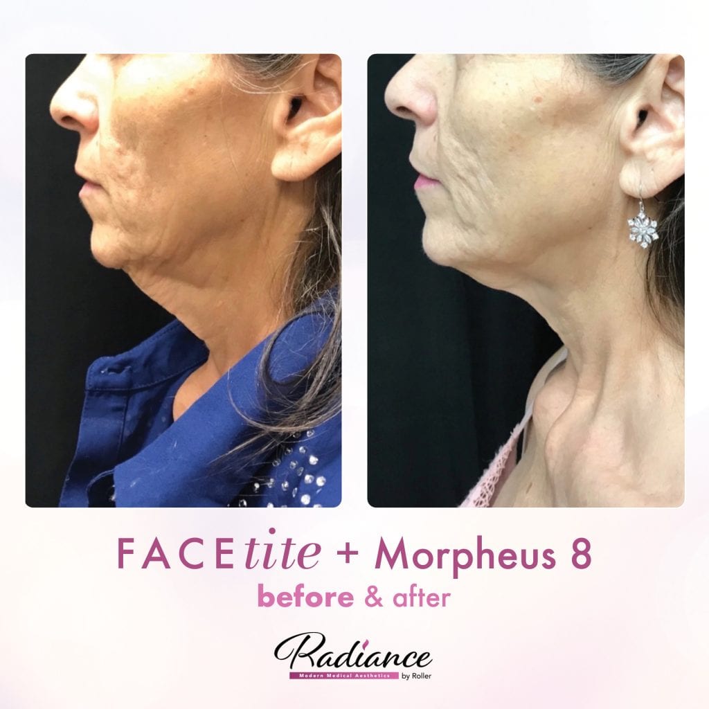 FaceTite Before & After Gallery - Patient 12858 - Image 1